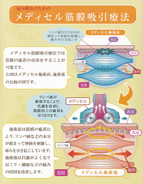 枚方市 なつめ鍼灸整骨院のメディセル筋膜吸引療法写真